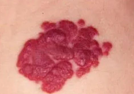 身上有小红小红_身上有小红是怎么回事_身上有个别小红点