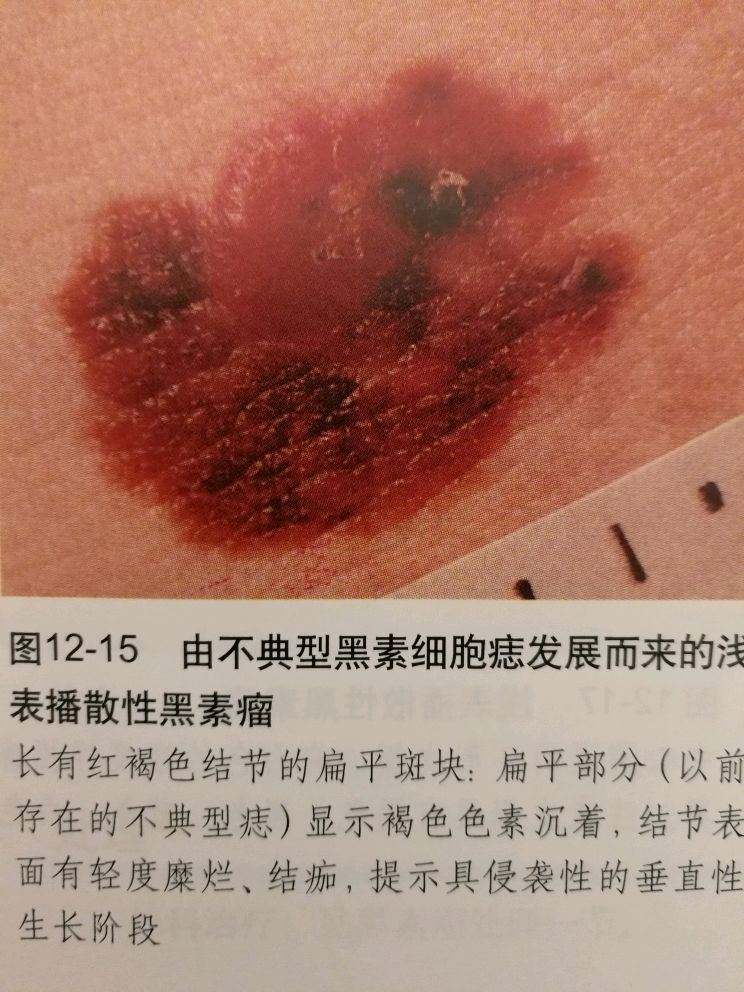 激光去除副雀斑作用大不大_激光去雀斑对皮肤有多大的害处_激光去除雀斑的副作用